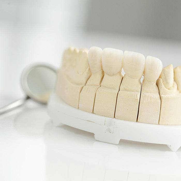 A dental bridge on a mouth mold